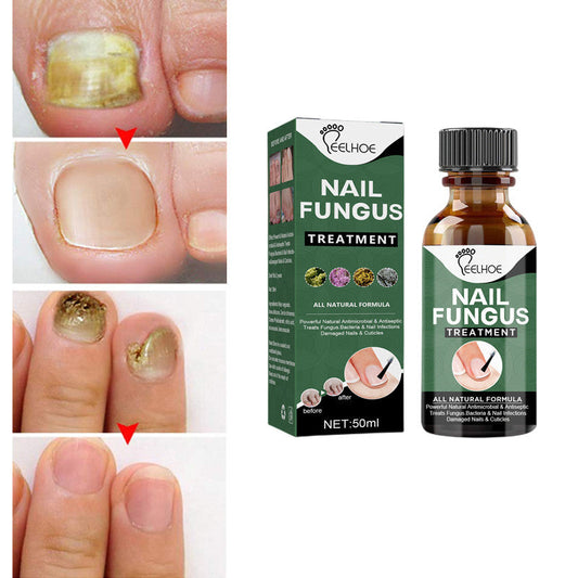 Nail Fungal Treatment Feet Care Essence Anti Infection Paronychia Onychomycosis Foot Toe Fungus Removal Gel Chinese Medicine