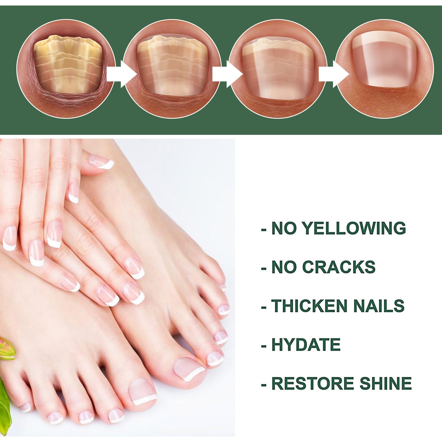 Nail Fungal Treatment Feet Care Essence Anti Infection Paronychia Onychomycosis Foot Toe Fungus Removal Gel Chinese Medicine