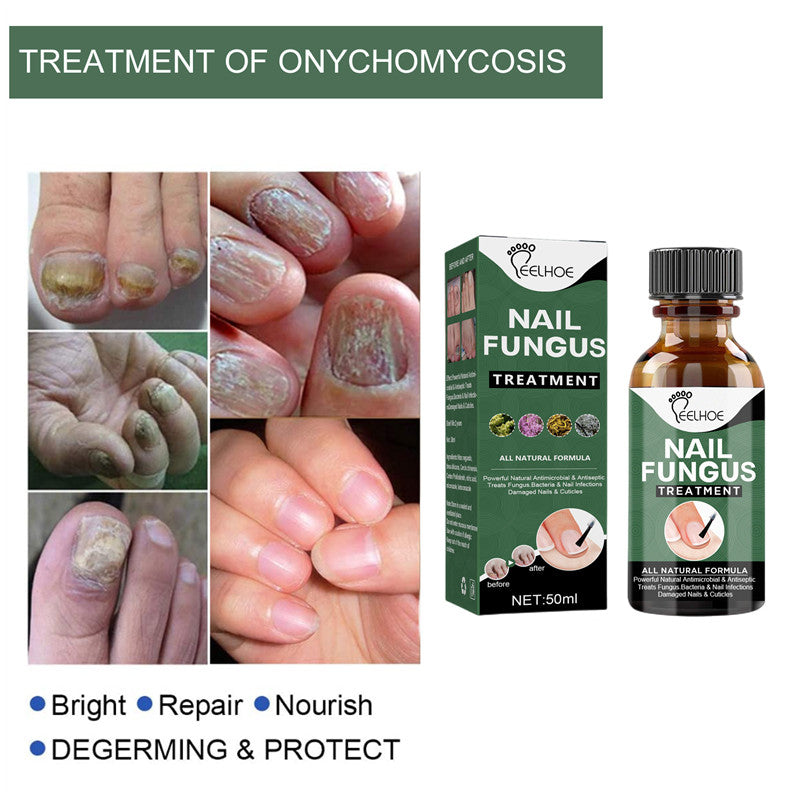 Nail Fungal Treatment Feet Care Essence Anti Infection Paronychia Onychomycosis Foot Toe Fungus Removal Gel Chinese Medicine