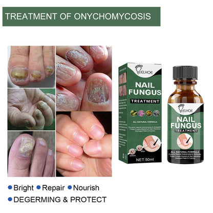 Nail Fungal Treatment Feet Care Essence Anti Infection Paronychia Onychomycosis Foot Toe Fungus Removal Gel Chinese Medicine