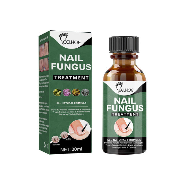 Nail Fungal Treatment Feet Care Essence Anti Infection Paronychia Onychomycosis Foot Toe Fungus Removal Gel Chinese Medicine 30ml