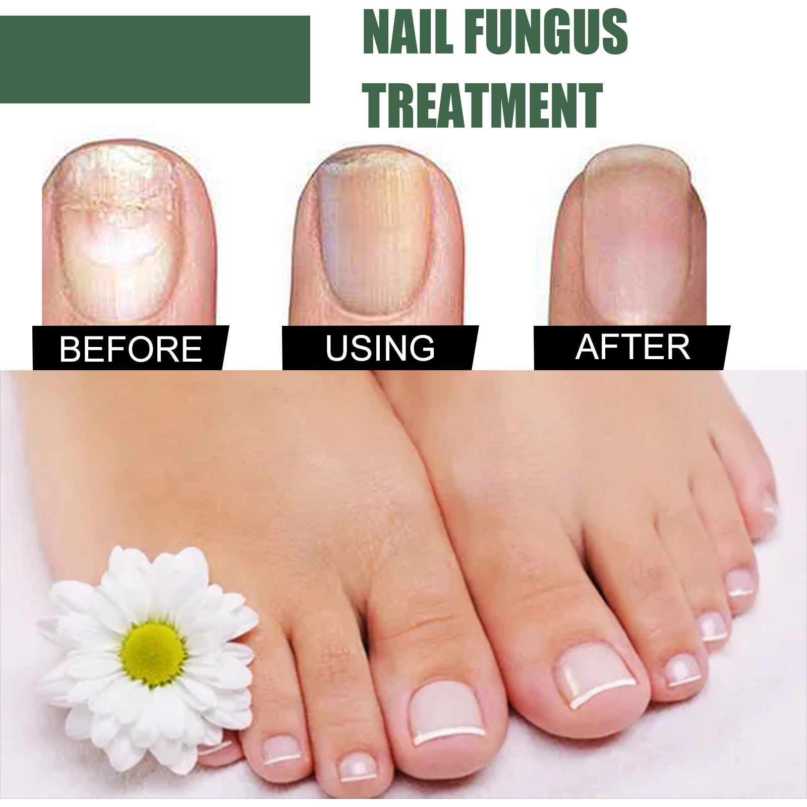 Nail Fungal Treatment Feet Care Essence Anti Infection Paronychia Onychomycosis Foot Toe Fungus Removal Gel Chinese Medicine